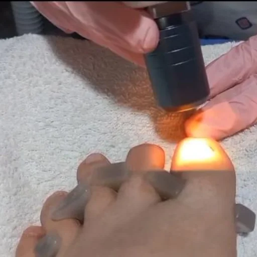 Tratamientos Onicomicosis con láser