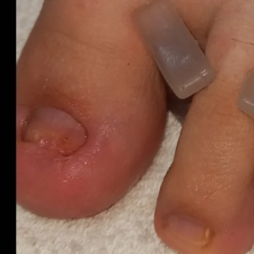 Tratamientos Onicomicosis con láser