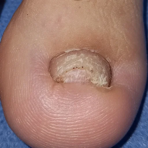 Tratamientos Onicomicosis con láser