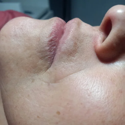 Microneeding