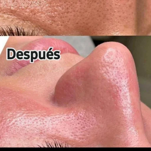 Limpieza facial