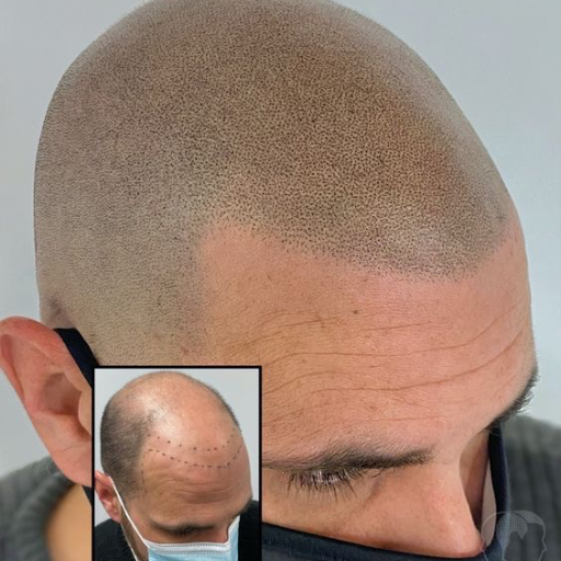 Scalp ( micro capilar) - imagen 5
