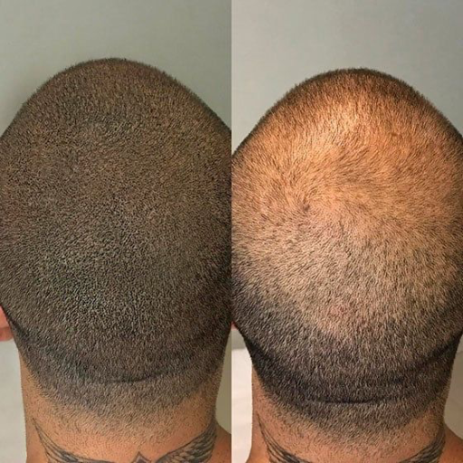 Scalp ( micro capilar) - imagen 2