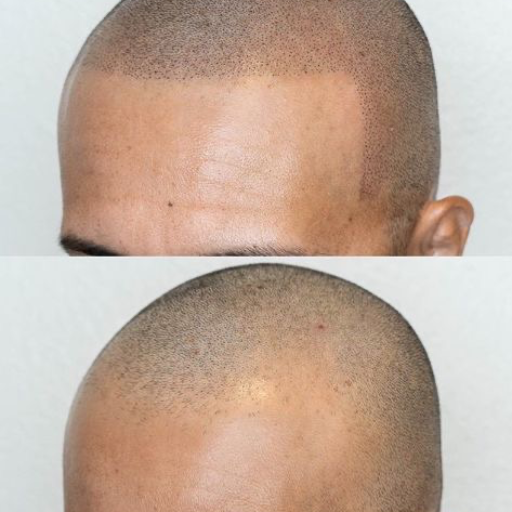 Scalp ( micro capilar) - imagen 4